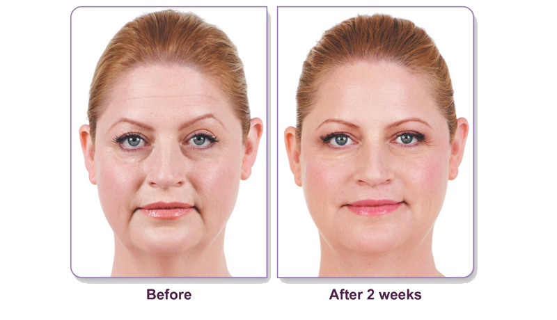 Juvederm