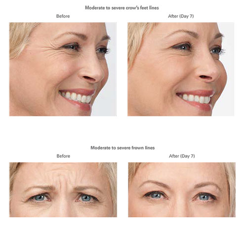 Botox | Plastic Surgery of Tulsa