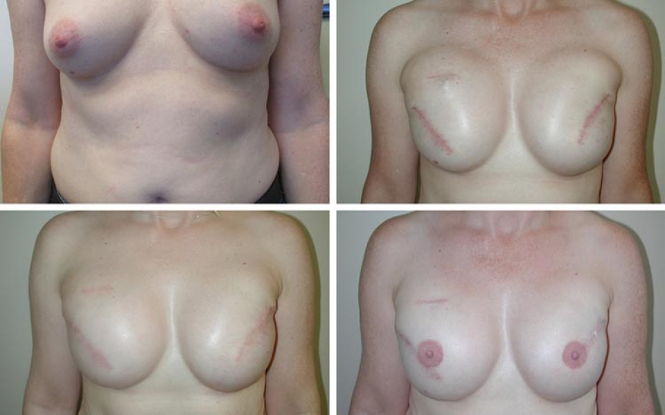 tulsa breast reconstruction