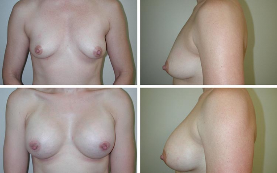 Breast Augmentation | Plastic Surgery of Tulsa