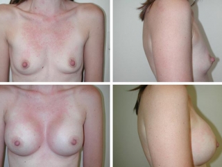 Breast Augmentation | Plastic Surgery of Tulsa