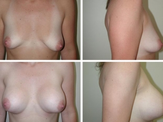 Breast Augmentation | Plastic Surgery of Tulsa