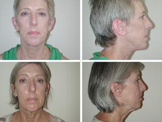 Facelift | Plastic Surgery of Tulsa