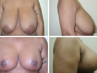 Tulsa breast reduction