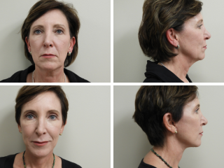 Tulsa facelift Dr. Stephen Paulsen