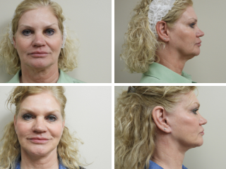 tulsa facelift dr stephen paulsen