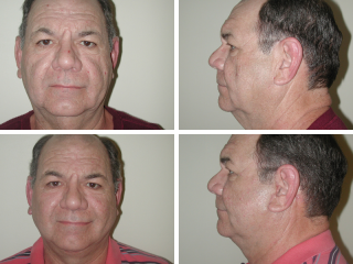 Tulsa facelift doctor