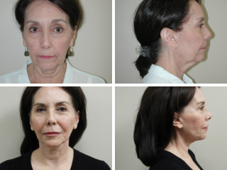 tulsa facelift doctor