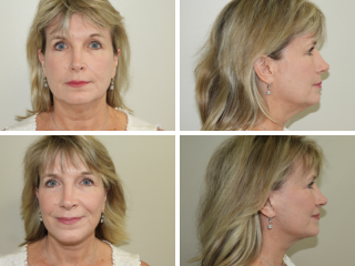 Tulsa facelift doctor