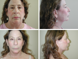tulsa facelift doctor