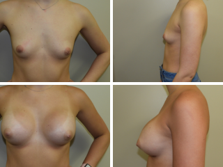 dr stephen paulsen breast augmentation