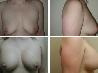 tulsa breast augmentation