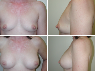 tulsa breast augmentation doctor