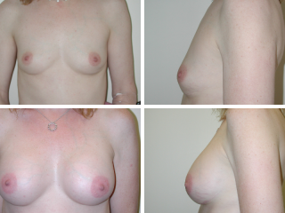tulsa breast augmentation