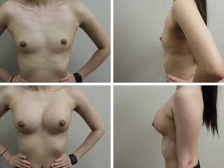 tulsa breast augmentation