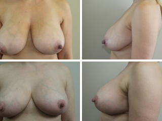 tulsa breast reduction