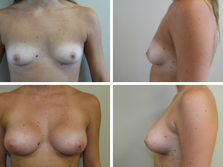 tulsa breast augmentation
