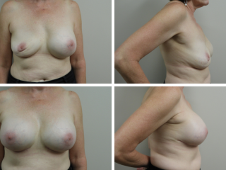 tulsa breast augmentation