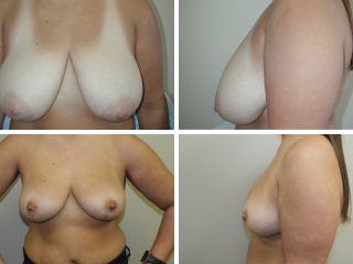 tulsa breast reduction