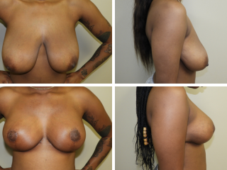 tulsa breast reduction