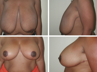 Tulsa breast reduction