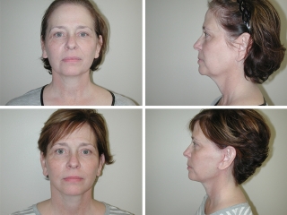 Facelift | Plastic Surgery of Tulsa