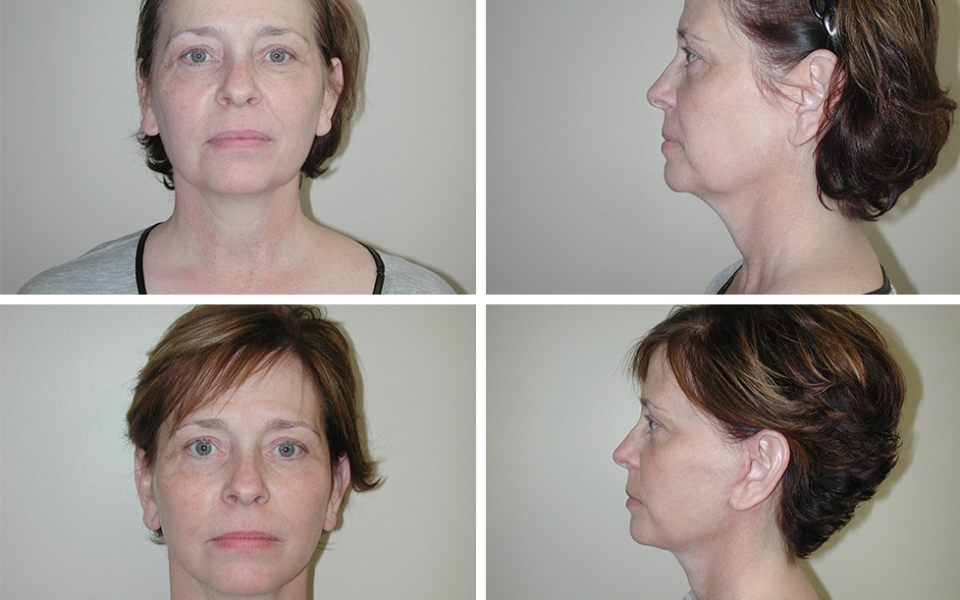 Facelift | Plastic Surgery of Tulsa