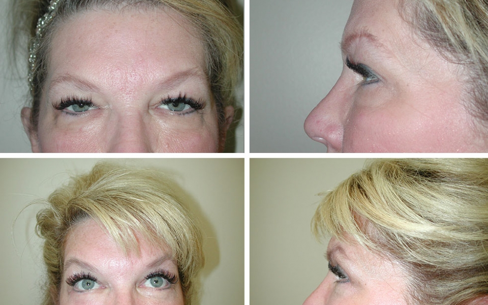 Blepharoplasty | Plastic Surgery of Tulsa