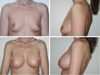 Breast Augmentation | Plastic Surgery of Tulsa
