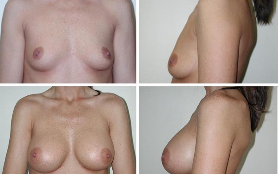 Breast Augmentation | Plastic Surgery of Tulsa