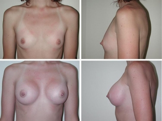 Breast Augmentation | Plastic Surgery of Tulsa