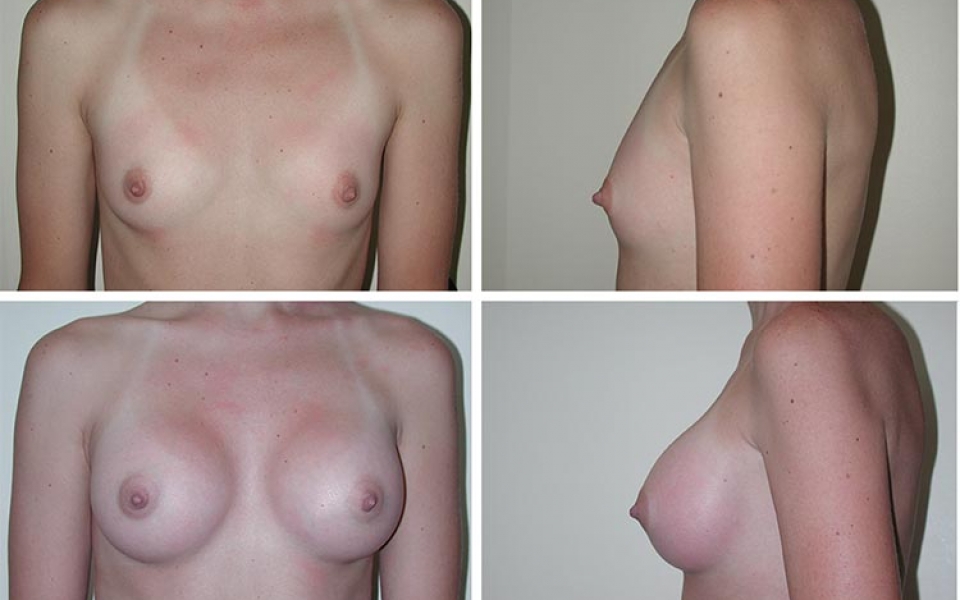 Breast Augmentation | Plastic Surgery of Tulsa