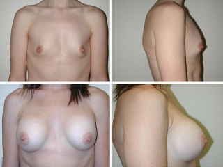Breast Augmentation | Plastic Surgery of Tulsa
