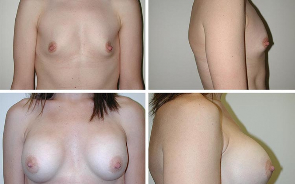 Breast Augmentation | Plastic Surgery of Tulsa