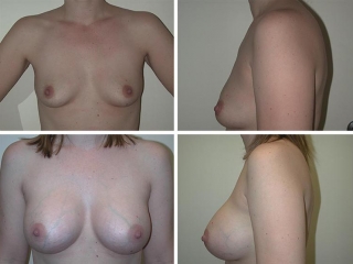 Breast Augmentation | Plastic Surgery of Tulsa