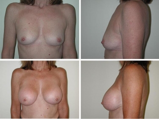 Breast Augmentation | Plastic Surgery of Tulsa