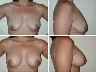 Breast Lift | Plastic Surgery of Tulsa