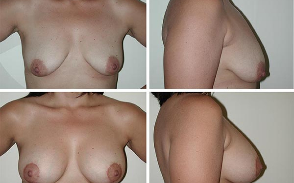 Breast Lift | Plastic Surgery of Tulsa