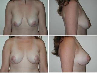 Breast Lift | Plastic Surgery of Tulsa