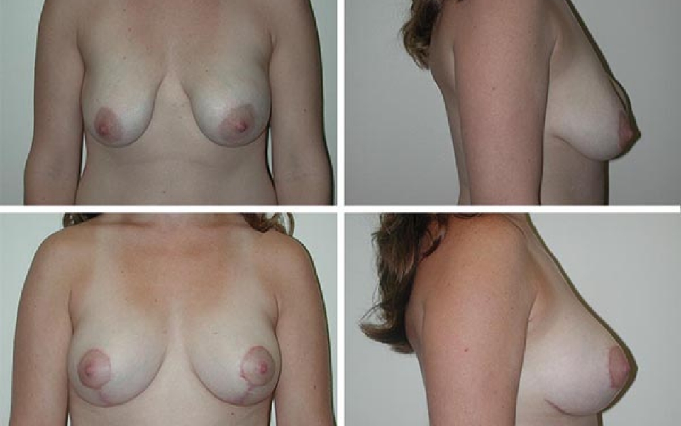 Breast Lift | Plastic Surgery of Tulsa