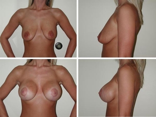 Breast Lift | Plastic Surgery of Tulsa