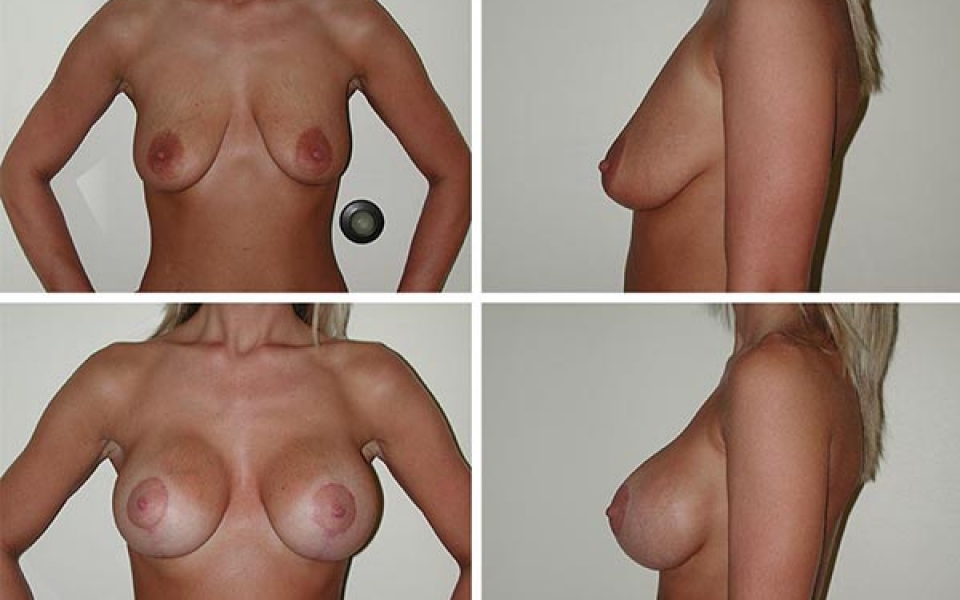 Breast Lift | Plastic Surgery of Tulsa