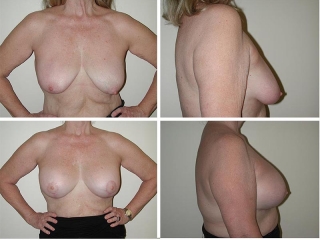 Breast Lift | Plastic Surgery of Tulsa