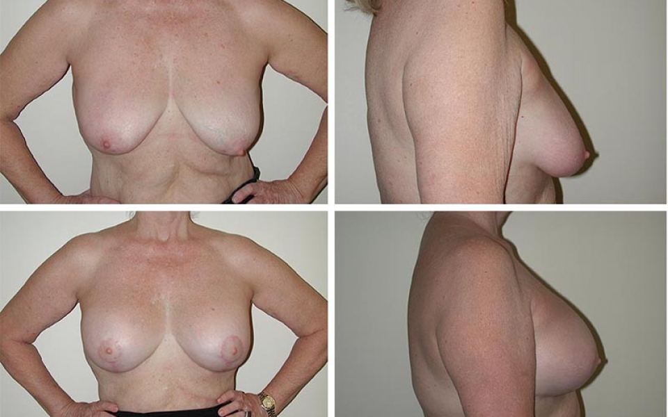 Breast Lift | Plastic Surgery of Tulsa