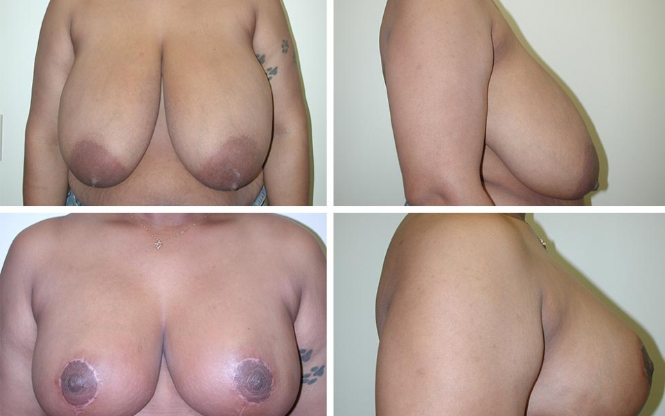 Breast Reduction | Plastic Surgery of Tulsa