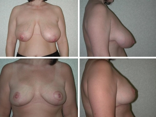 Breast Reduction | Plastic Surgery of Tulsa