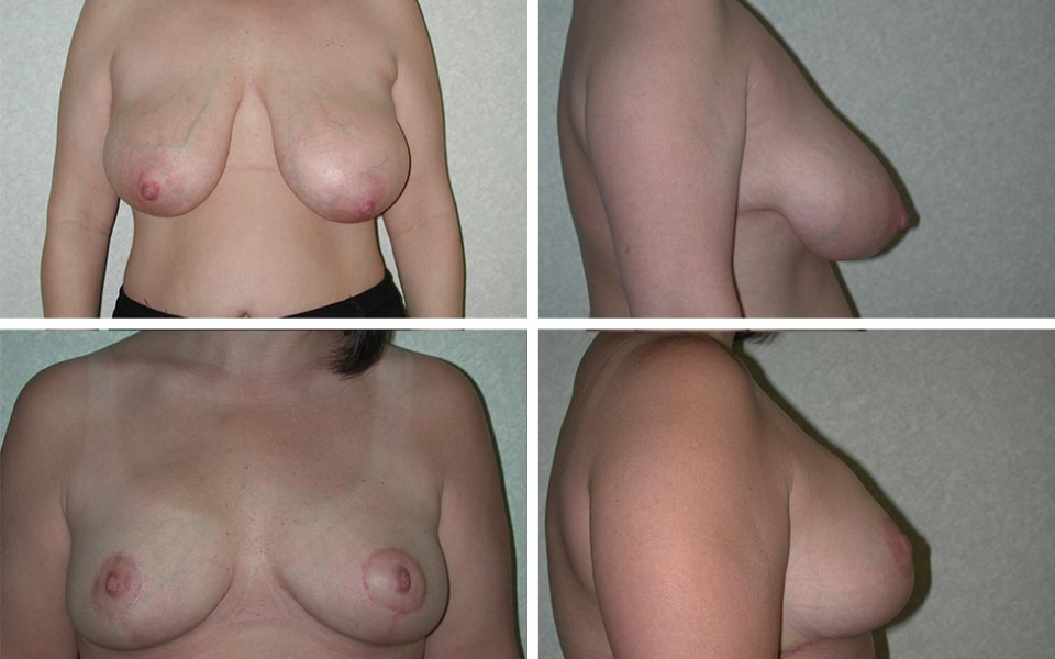 Breast Reduction | Plastic Surgery of Tulsa