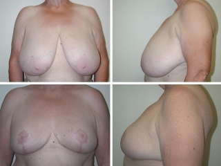 Breast Reduction | Plastic Surgery of Tulsa