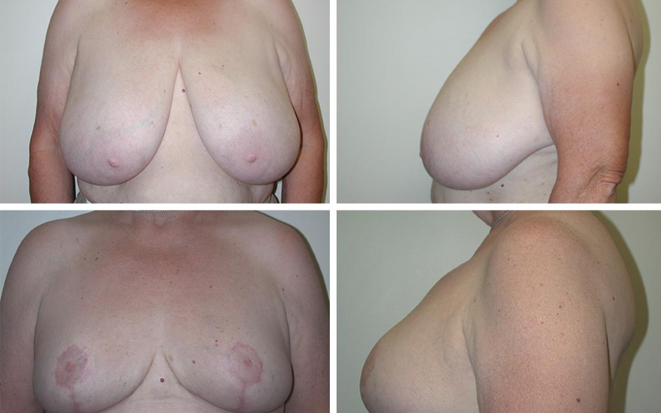 Breast Reduction | Plastic Surgery of Tulsa