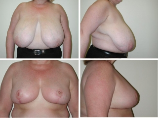 Breast Reduction | Plastic Surgery of Tulsa